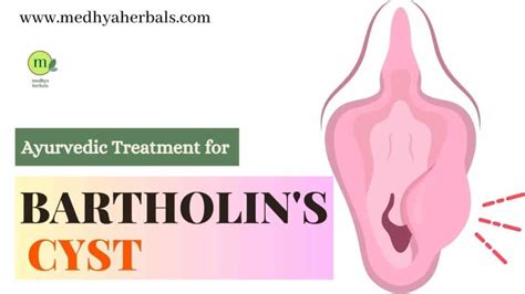 Bartholins Cyst Treatment An Ayurvedic Doctors Guide