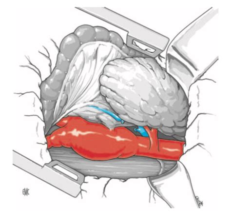 Chirurgie Vasculaire POLYCLINIQUE BEZANNES anévrysmes aorte