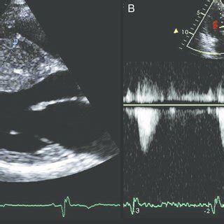 Echocardiogram stress test results revealing polymorphic ventricular ...