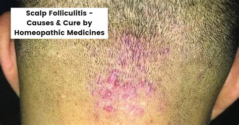 Scalp Folliculitis Treatment - Causes & Cure by Homeopathy