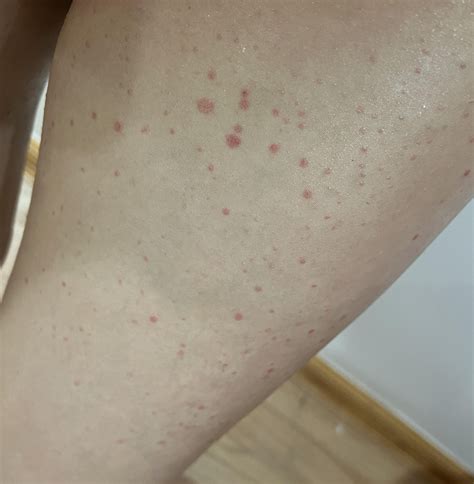 Red spots on my legs : r/DermatologyQuestions