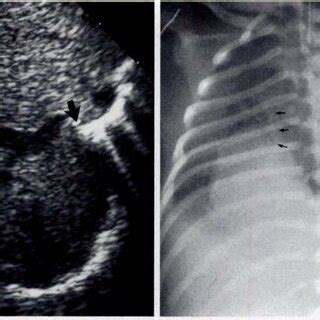 PDF Pediatric Case Of The Day Hypogenetic Lung Syndrome Scimitar