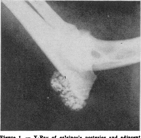 Figure 1 From Calcinosis Circumscripta A Case Report With X Ray