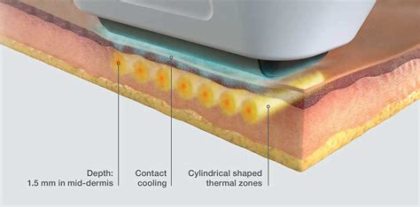 Sofwave™ Facial Rejuvenation Cranley Clinic London