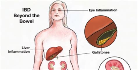 ULTRASOUNDS IN IBD Nutrition 4 IBD