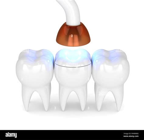 D Render Of Teeth With Dental Polymerization Lamp And Light Cured