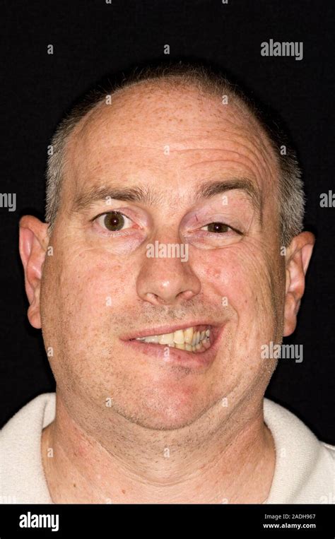 Model Released Bell S Palsy Face Of A Smiling 48 Year Old Man With Bell S Palsy A Unilateral