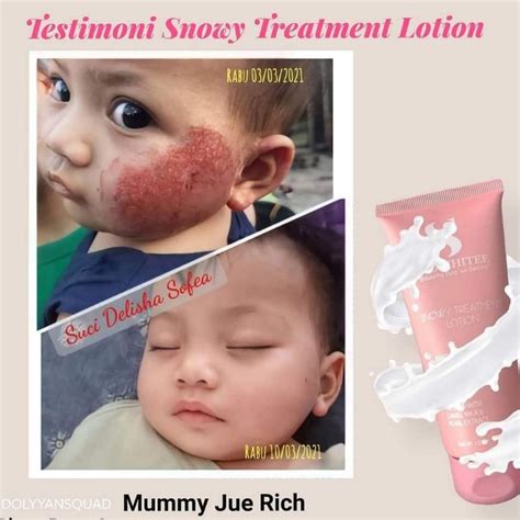 Ekzema Ruam Parut Treatment Lotion Snowhite Shopee Malaysia