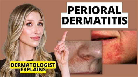 Dermatologist Explains Perioral Dermatitis What It Looks Like Causes