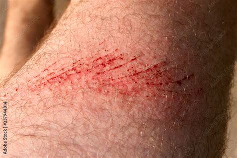 Foto De Scratch Skin Wound Or Cut On The Skin Red Blood Hairy Part