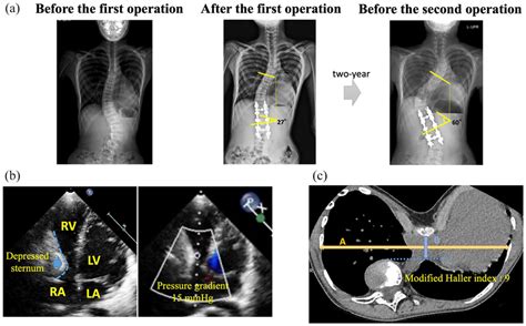 Preoperative Examination Chest X Ray Photograph Xp Transthoracic