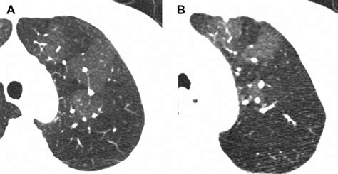 Imaging Of Pulmonary Manifestations Of Connective Tissue Disease Radiologic Clinics