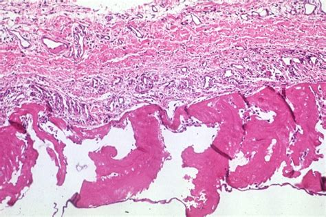 Uremic Pericarditis Pathophysiology Wikidoc