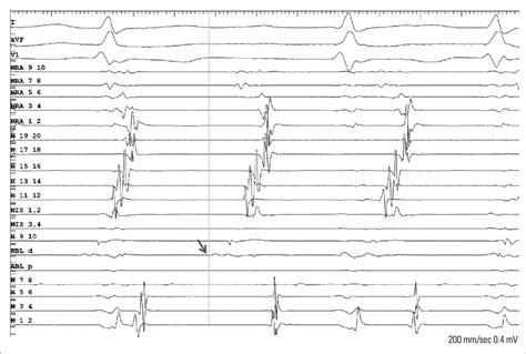 Intracardiac Electrograms And Ablation Signals At The Inferior Vena