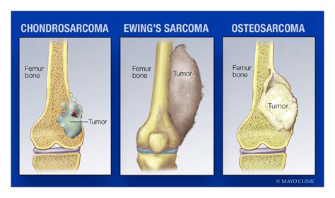 Mayo Clinic Podcast Be Aware Of The Rare Cancer Called Sarcoma