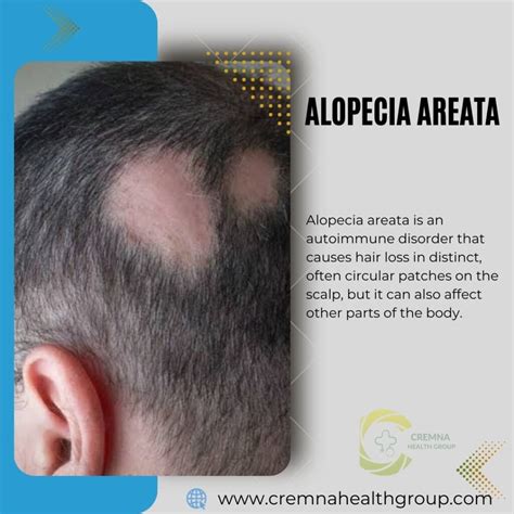 Alopecia Areata Causes And Treatments Cremna Health Group