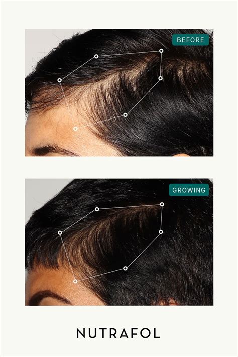 How To Stop Alopecia Areata From Spreading This Non Invasive Solution