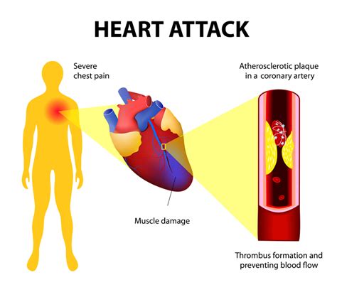 Chest Pain, Shortness of Breath, and Nausea: Are These Always Signs of a Heart Attack?