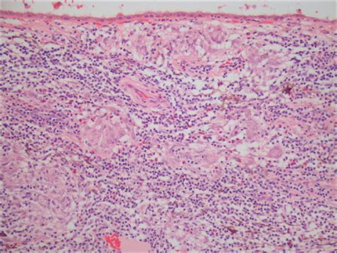 Uveitis Pathophysiology Wikidoc