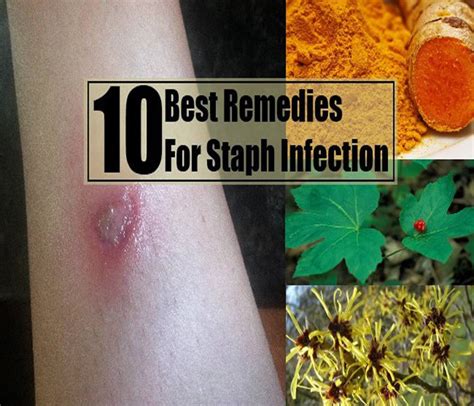 Staphylococcuss Causes Symptoms Treatment Diagnosis And Prevention Galleria Community