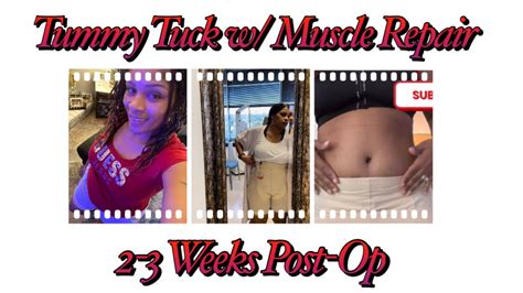 Vlog 3 Tummy Tuck Wmuscle Repair Week 2 3 Post Op Update Youtube