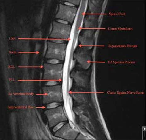 Normal Lumbar Mri Images