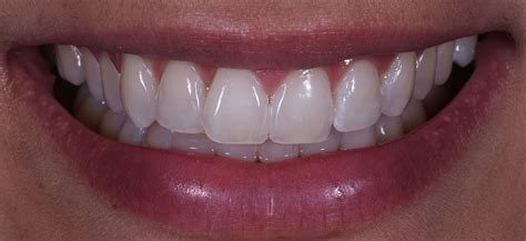 Professional Teeth Whitening Dr Alex Midtown Nyc Cosmetic Dentist