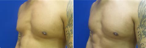 Before And After Gynecomasia Surgery Gallery Nyc Gynecomastia Center