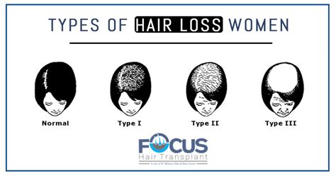 Different Types of hair loss in women