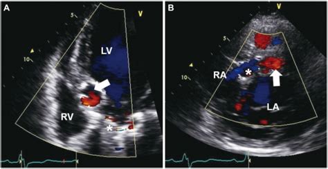 Transthoracic Echocardiography In The Apical 5 Chamber View A And The