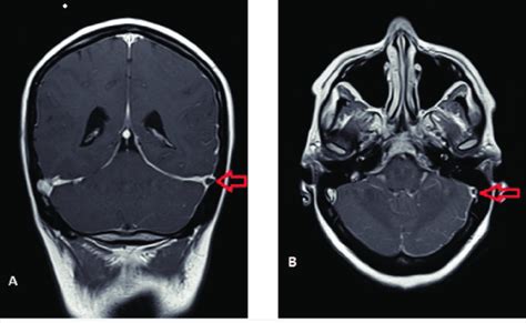 Trombosis Del Seno Cavernoso Fosa Craneal Media Otosection