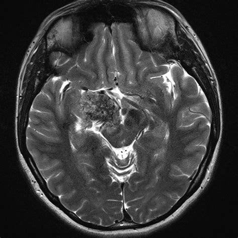 Chondrosarcoma Image Radiopaedia Org