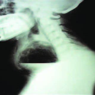 X Ray Neck Lateral View Showing Air Fluid Level In Enlarged Cyst Of