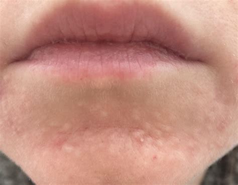 How To Get Rid Of Bumps On Chin R Skincareaddicts