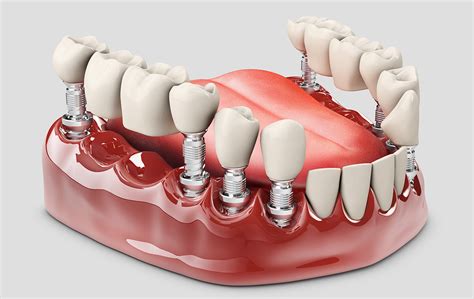 What are Fixed Partial Dentures - Los Angeles, CA Dentures