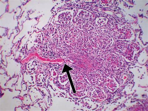 Pulmonary Tuberculosis Role Of Radiology In Diagnosis And Management