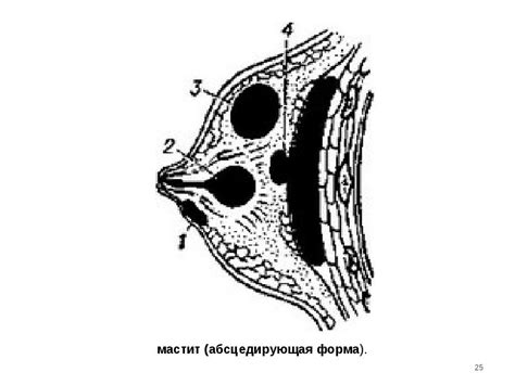 Острый мастит презентация доклад проект