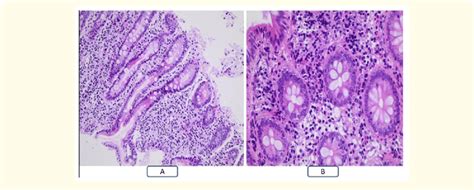 Histopathology Of The Duodenal And Ileal Biopsies A Fragment Of Download Scientific Diagram