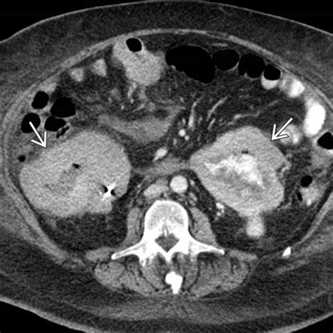 Metastatic Melanoma Radiology Key