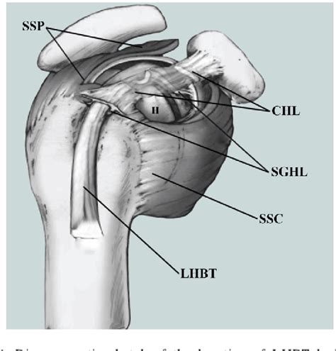 Figure From Small Incision Open Distal Subpectoral Vs Arthroscopic