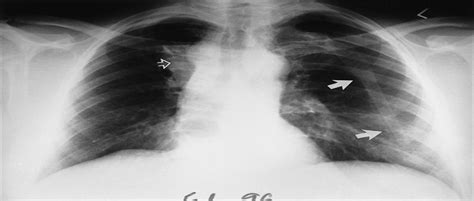 Supernumerary Intrathoracic Ribs Imaging Features Of Two Ca