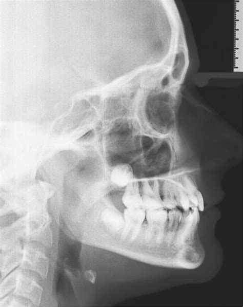 Scielo Brasil Orthodontic Management Of Bilateral Maxillary Canine