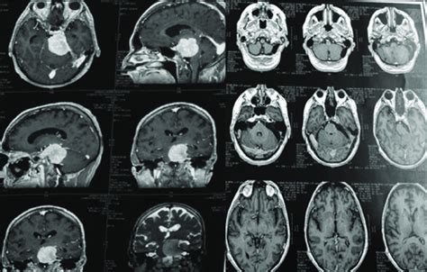 Meningioma Petroclival Grande Resecado Por Abordaje Suboccipital Se