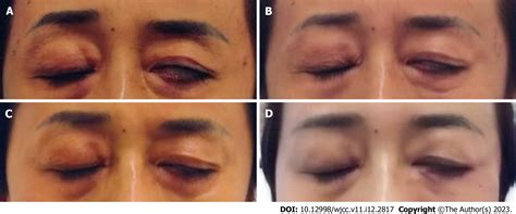 Recovery From Bells Palsy After Treatment Using Uncultured Umbilical