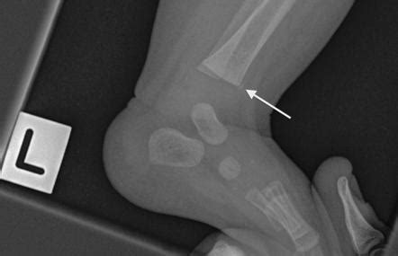 Metaphyseal corner fracture | Radiology Reference Article | Radiopaedia.org