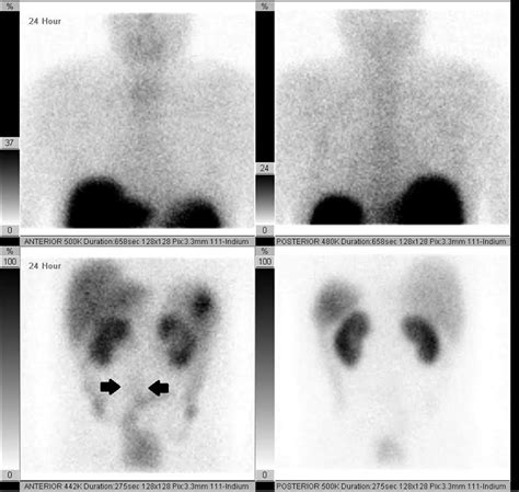 Octreotide Scan