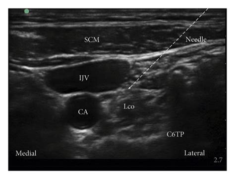 Horizontal Ultrasound Imaging Of The Stellate Ganglion Block Scm Porn