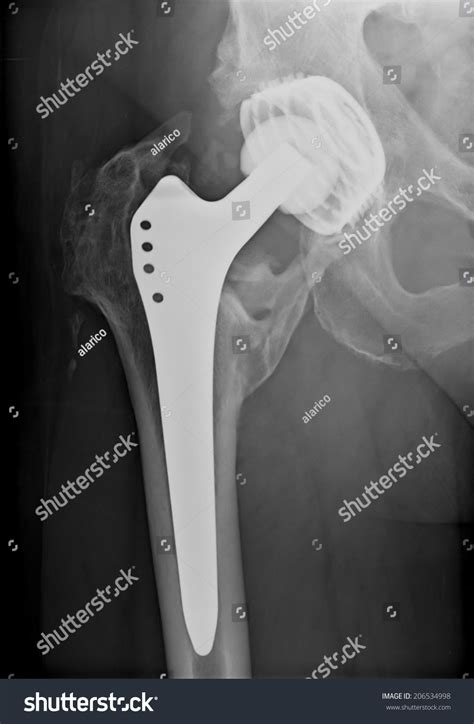 Xray Imaging Permanent Total Hip Arthroplasty Stock Photo 206534998 ...