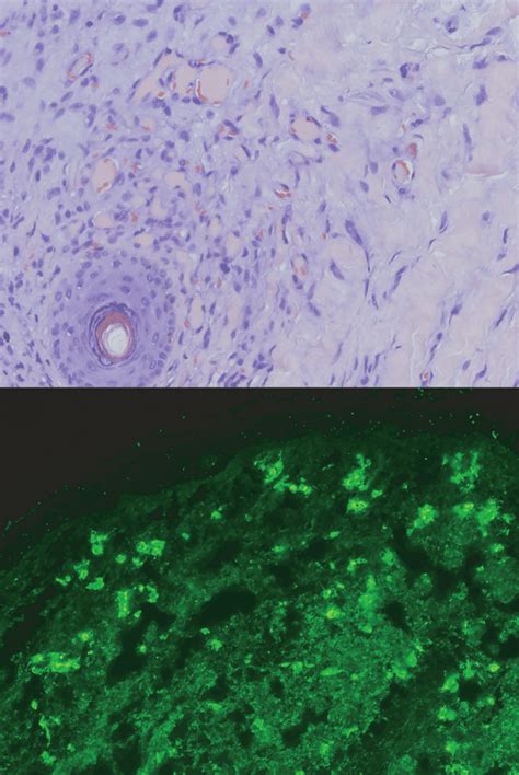 small bilateral ulcers   fibrinous base  purpuric circinate