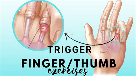 Get Rid Of Trigger Finger And Or Trigger Thumb With Nichelle Thomson